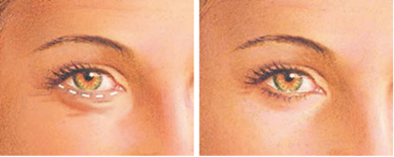 blefaroplastia