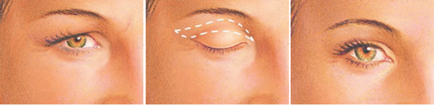 como-fica-o-antes-e-despois-blefaroplastia