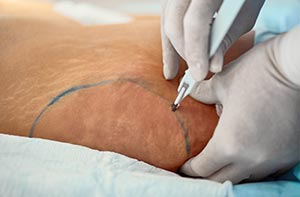 liposuction-perguntas-fundamentais